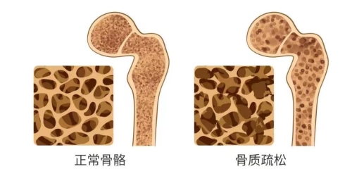 骨质疏松.jpg